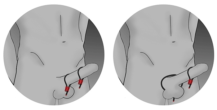 ElectraStim - Prestige Electraloops 2x Adjustable Cock Ring (red)